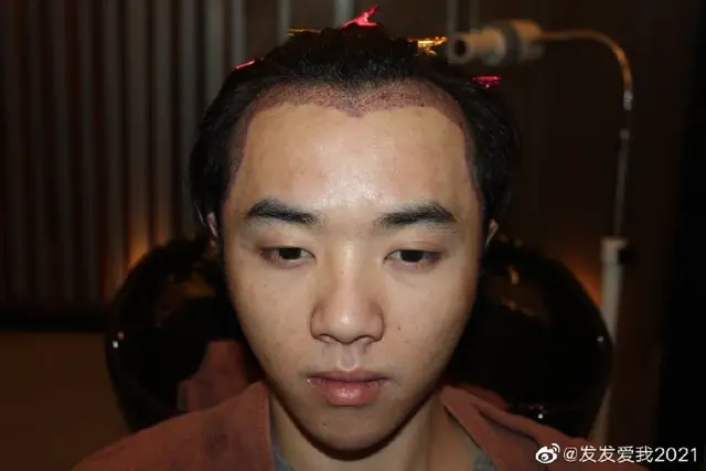 刘恺威整容后遗症_华晨宇整容_娱乐圈没整过容的明星